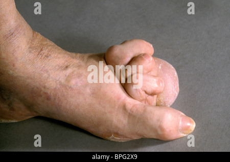 Déformation de l'orteil dans un patient souffrant d'arthrite rhumatoïde. Banque D'Images