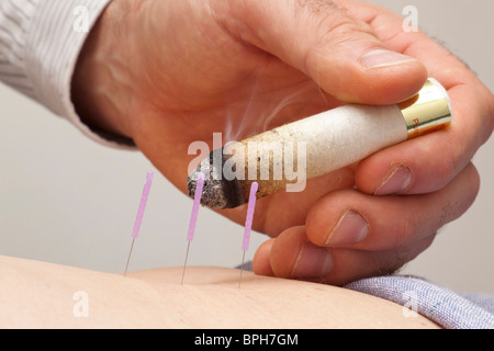 Les aiguilles d'acupuncture au patient en cours de chauffage avec la moxibustion stick Banque D'Images