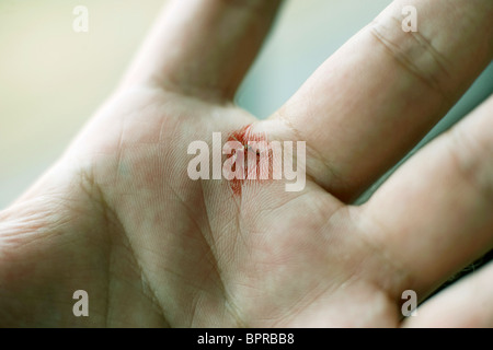 Détail de la main après l'écrasement d'un moustique rempli de sang au Malawi. Banque D'Images