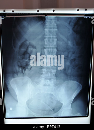 La contrebande de drogues saisies par la UK Border Agency. X-ray montrant les paquets qui ont été enregistrées jusqu'avalé par un trafiquant de drogue Banque D'Images