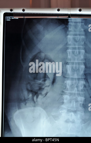 La contrebande de drogues saisies par la UK Border Agency. X-ray montrant les paquets qui ont été enregistrées jusqu'avalé par un trafiquant de drogue Banque D'Images