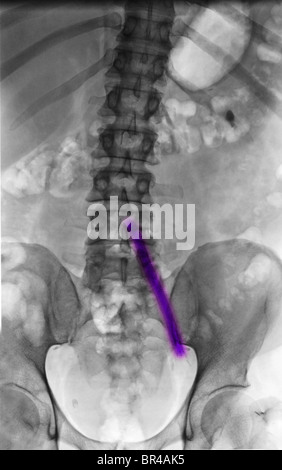 Radiographie d'un homme de 51 ans qui avait un fils aorto-iliaques-mesh par greffe Banque D'Images