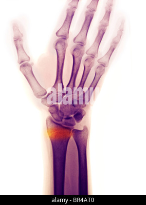 X-ray de l'avant-bras d'une femme de 29 ans montrant une fracture déplacée de la partie distale du radius Banque D'Images