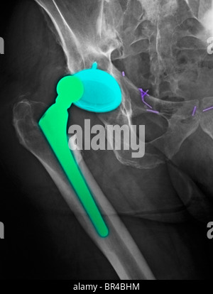 X-ray de la hanche d'un homme âgé de 69 ans avec une luxation de prothèse de hanche Banque D'Images