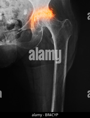 X-ray montrant une arthrite dégénérative de la hanche d'une femme de 85 ans Banque D'Images