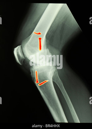 X-ray du genou d'un homme de 45 ans qui a subi une chirurgie pour réparer une déchirure du ligament croisé antérieur, ACL Banque D'Images