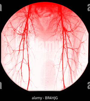 Angiographie aortique normale de la artères fémorales pour les jambes Banque D'Images