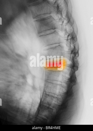 Épine dorsale x-ray en vue latérale montrant un T7 dans une fracture de compression 77 year old man Banque D'Images