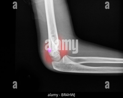 X-ray montrant une fracture de l'humérus distal à un garçon de 7 ans. Banque D'Images