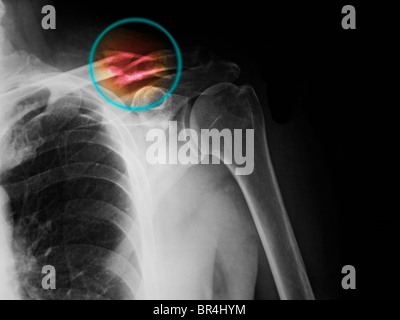 X-ray colorisée d'une fracture de la clavicule en a 62 ans, homme Banque D'Images