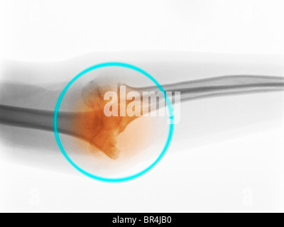 X-ray de coude d'une femelle de 8 ans, montrant une fracture déplacée de l'humérus distal Banque D'Images