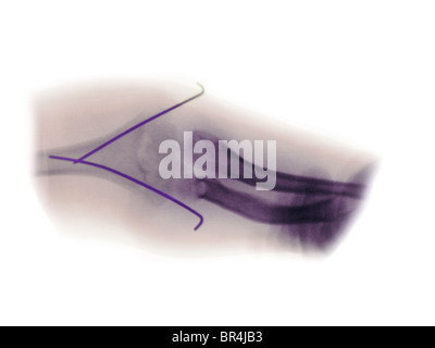 X-ray montrant un coude fracture dans une fillette de 8 ans Banque D'Images