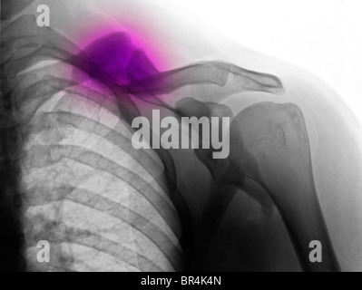 X-ray montrant une fracture guérie de la clavicule, clavicule, d'un homme de 34 ans Banque D'Images