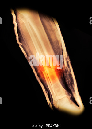 X-ray de la jambe d'un homme de 37 ans qui lui a fracturé le tibia et le péroné dans un accident de moto Banque D'Images