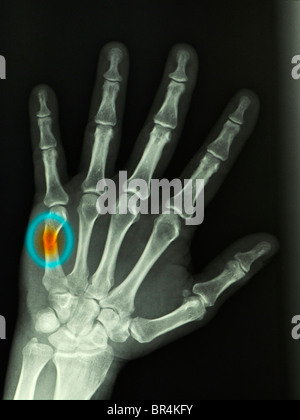 X-ray la main d'un homme de 57 ans montrant un 5e métacarpe (fracture du boxeur) un mur de poinçonnage soutenue Banque D'Images