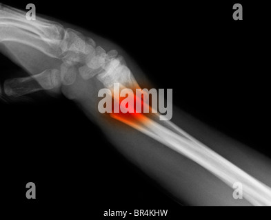 X-ray de l'avant-bras d'un garçon de 11 ans, montrant une fracture oblique de la partie distale du cubitus et radius Banque D'Images
