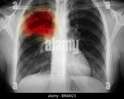 Radiographie montrant la pneumonie dans le lobe supérieur droit du poumon d'une femme de 17 ans Banque D'Images