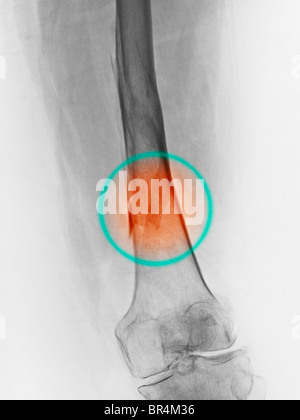 Pattes x-ray d'une femme de 67 ans qui est tombé et s'est fracturée le fémur Banque D'Images