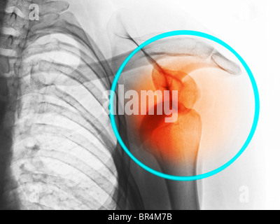 X-ray montrant une luxation de l'épaule dans un homme de 26 ans Banque D'Images