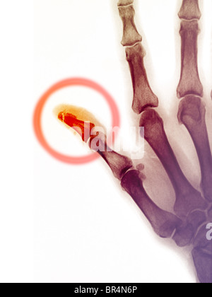 Hand x-ray of a 68 year old man qui fracture de l'extrémité de son pouce Banque D'Images