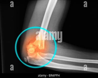 X-ray de coude d'une femelle de 8 ans, montrant une fracture déplacée de l'humérus distal Banque D'Images