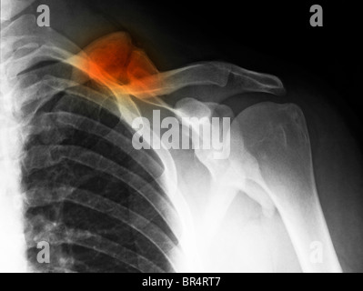 X-ray montrant une fracture guérie de la clavicule, clavicule, d'un homme de 34 ans Banque D'Images