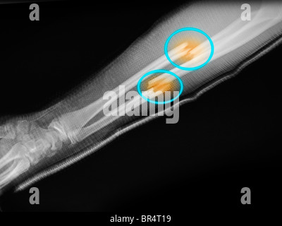 X-ray montrant une fracture de l'avant-bras d'un garçon de 16 ans Banque D'Images