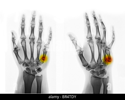 X-ray mains montrant un 5e métacarpien fracture dans une femme âgée de 20 ans Banque D'Images