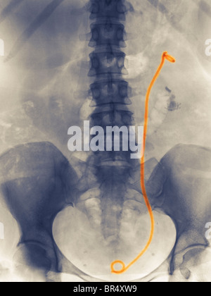 X-ray montrant une endoprothèse du rein à la vessie d'une femme de 46 ans qui avait des antécédents de calculs rénaux Banque D'Images
