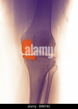 Genou x-ray of a 49 year old man montrant un remplacement du genou partielle impliquant le condyle médial Banque D'Images