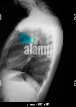 Radiographie d'un garçon de 5 ans montrant un infiltrat lobe supérieur gauche évocateurs d'une pneumonie. Banque D'Images