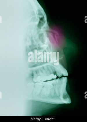 X-ray montrant une fracture du nez chez une femme qui est tombé Banque D'Images