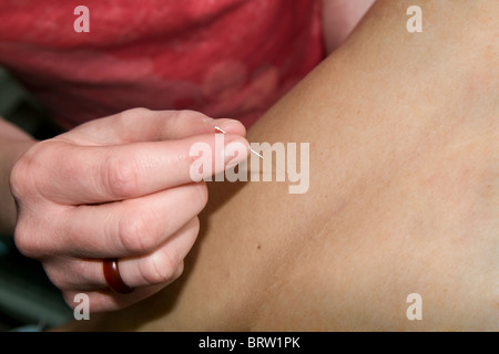 Acupuncteur femelle placer des aiguilles dans des points de retour sur mans retour Banque D'Images