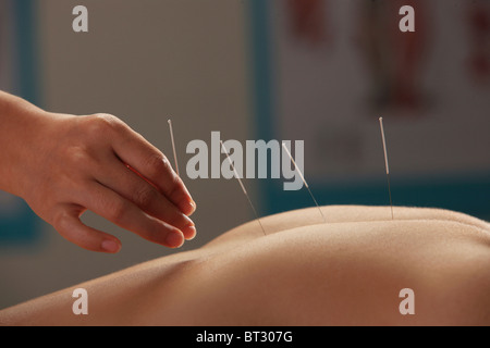 Doctor putting acupuncture on woman's back, close-up Banque D'Images