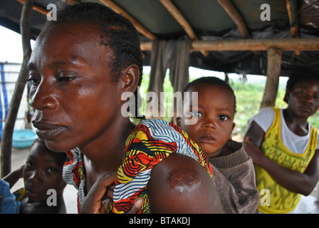 Des réfugiés libériens femme avec balle dans son épaule, camp de transit de Tabou, Côte d'Ivoire, Afrique de l'Ouest Banque D'Images