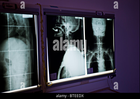 X-ray de la tête et du cou Banque D'Images