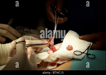 Tumeurs du testicule, de l'urologie chirurgie de déplacement Banque D'Images