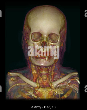 3D CT scan de la tête d'un homme âgé Banque D'Images