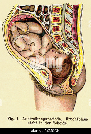 Médecine, gynécologie, naissance, phase peu avant l'accouchement, lithographie, Allemagne, vers 1905, droits additionnels-Clearences-non disponible Banque D'Images