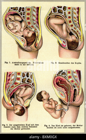 Médecine, gynécologie, naissance, phases, lithographie, Allemagne, vers 1905, droits additionnels-Clearences-non disponible Banque D'Images