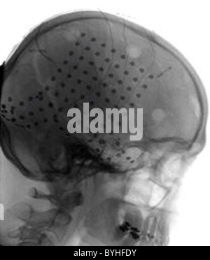 BRAIN COMPUTER LINK Le lien direct entre le cerveau humain et d'un ordinateur, d'un soi-disant électroencéphalogrammes afin Interface (BCI), Banque D'Images