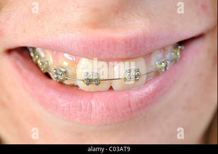 Girl with braces sur ses dents Banque D'Images