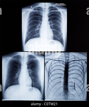 X-Ray Image de la poitrine en bonne santé Banque D'Images