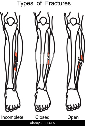 Types de fractures des os de l'illustration Banque D'Images