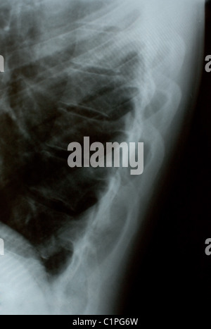 La xray photo d'un os humain Banque D'Images