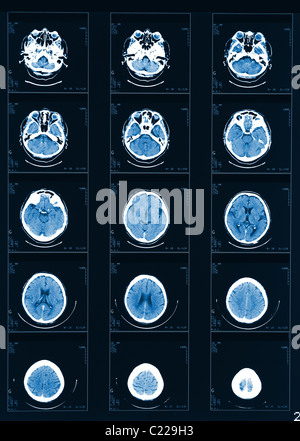 X-ray computed tomography fond tête fine Banque D'Images