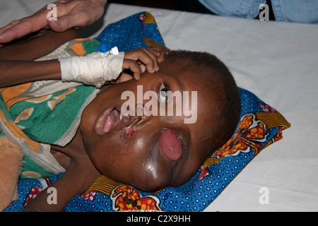 Jeune garçon africain avec de graves symptômes de cancer de l'hôpital Burkitts côte de Mombasa au Kenya Banque D'Images