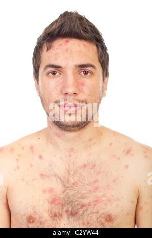 Close up of man face avec la varicelle isolé sur fond blanc Banque D'Images