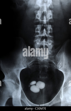 X-ray photo authentique des pierres de rein vessie - ureterolithiasis dans Banque D'Images
