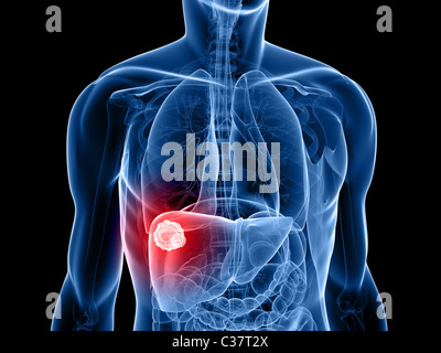 cancer du foie Banque D'Images